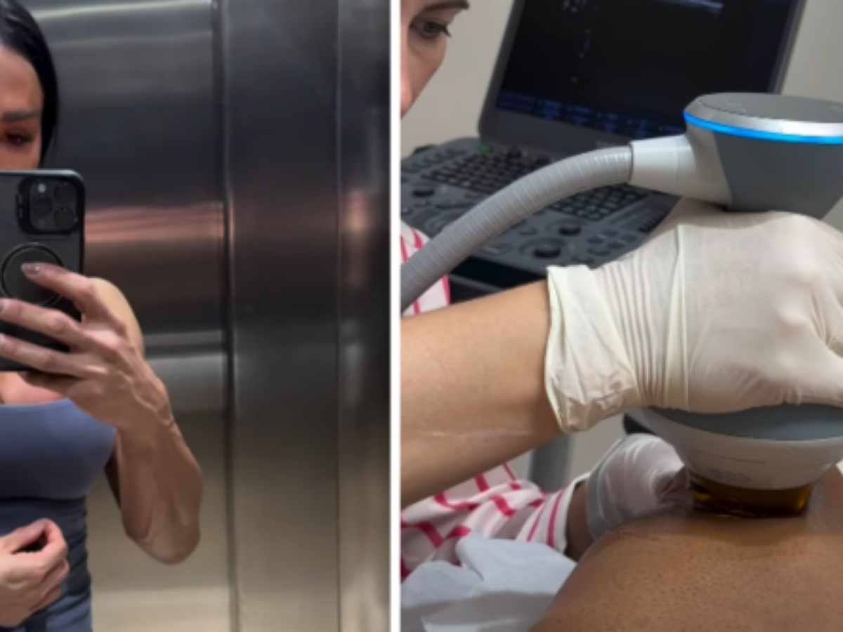 Gracyanne Barbosa recorre a punção para retirar líquido do joelho devido à 'Dança dos Famosos'